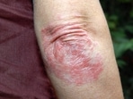Plaque psoriasis: Causes, symptoms and treatments you must know (Twitter/MDedgeDerm) Plaque psoriasis: Causes, symptoms and treatments you must know (Twitter/MDedgeDerm)