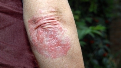 Plaque psoriasis: Causes, symptoms and treatments you must know (Twitter/MDedgeDerm) Plaque psoriasis: Causes, symptoms and treatments you must know (Twitter/MDedgeDerm)