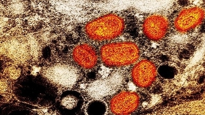 After peaking in August, monkeypox cases have been declining globally (NIAID/AP/picture alliance) After peaking in August, monkeypox cases have been declining globally (NIAID/AP/picture alliance)
