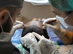 Haircare tips: Here's what you should know pre and post-hair transplant surgery Haircare tips: Here's what you should know pre and post-hair transplant surgery