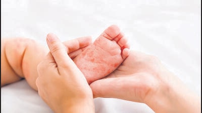 Measles virus. Mother holding tiny baby foot with red rash, closeup (Shutterstock) Measles virus. Mother holding tiny baby foot with red rash, closeup (Shutterstock)