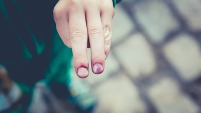 Bleeding easily: Other symptoms may include bruising or bleeding easily, including nosebleeds. (Unsplash) Bleeding easily: Other symptoms may include bruising or bleeding easily, including nosebleeds. (Unsplash)