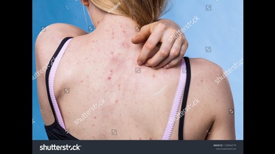 Symptoms of the disease are similar to that of vector-borne diseases and include fever, headache, body ache, rashes and muscle pain (For representation)