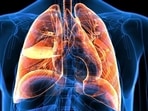 Lung cancer is the uncontrolled growth of abnormal cells that start off in one or both lungs.(Shutterstock) Lung cancer is the uncontrolled growth of abnormal cells that start off in one or both lungs.(Shutterstock)