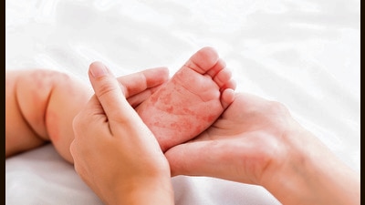 Many parts of Maharashtra have reported measles outbreak. (HT file photo)