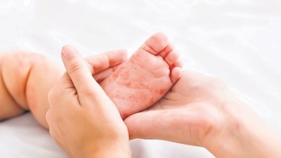 Unvaccinated children are more at risk of getting measles and have 70% higher mortality risk compared with vaccinated children. (Shutterstock) Unvaccinated children are more at risk of getting measles and have 70% higher mortality risk compared with vaccinated children. (Shutterstock)