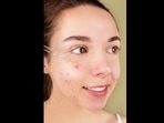 Beauty and skincare: Top tips to fade away post-acne spots (Anna Nekrashevich) Beauty and skincare: Top tips to fade away post-acne spots (Anna Nekrashevich)