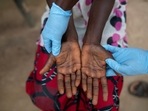"Both names will be used simultaneously for one year while 'monkeypox' is phased out," the global health organisation said.