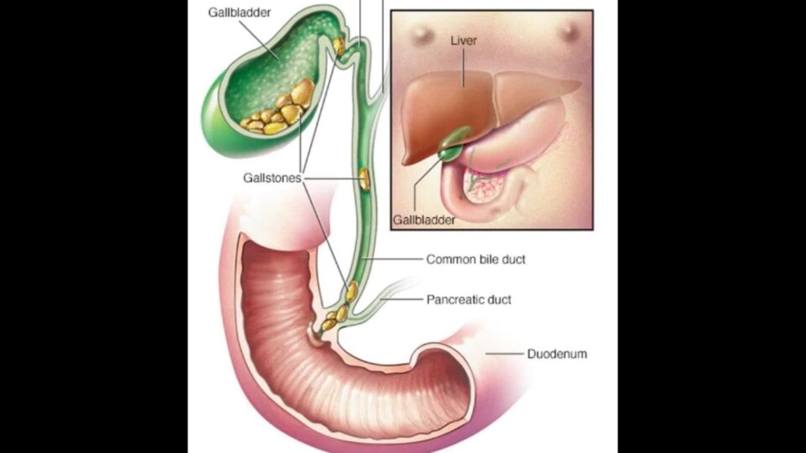 Inflamed gallbladder on sale without gallstones