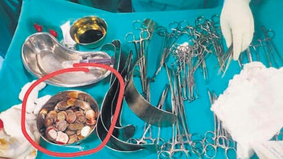 The man had swallowed coins of various denominations weighing a total of 1.5 kg over two to three months, said a doctor. (HT Photo)