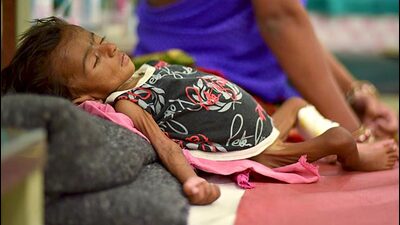 At least 20 per cent of children who have been identified by the Zilla Parishad (ZP) as malnourished have not shown any sign of improvement. (REPRESENTATIVE IMAGE) At least 20 per cent of children who have been identified by the Zilla Parishad (ZP) as malnourished have not shown any sign of improvement. (REPRESENTATIVE IMAGE)