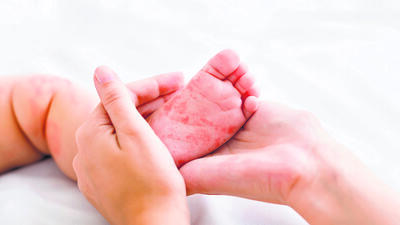 According to information shared by the Brihanmumbai Municipal Corporation (BMC), the child had not received the measles vaccination. (Shutterstock)