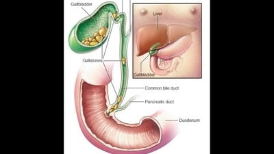 Myths about gallstones: Is normal life possible after removing gallbladder? (Twitter/drhungo) Myths about gallstones: Is normal life possible after removing gallbladder? (Twitter/drhungo)