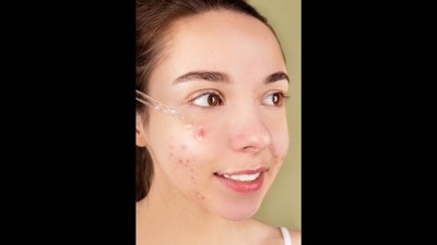 Beauty and skincare: Top tips to fade away post-acne spots (Anna Nekrashevich) Beauty and skincare: Top tips to fade away post-acne spots (Anna Nekrashevich)