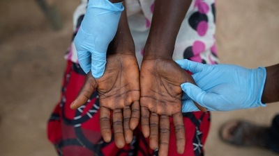 "Both names will be used simultaneously for one year while 'monkeypox' is phased out," the global health organisation said. (REUTERS)
