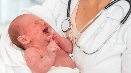 Measles is highly contagious and can be dangerous especially for babies and young children(Shutterstock)