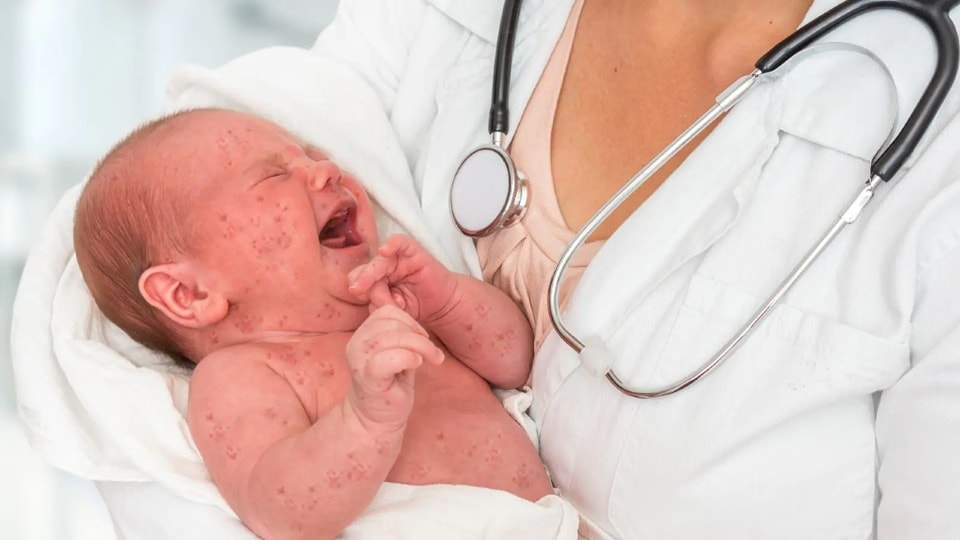 Measles is highly contagious and can be dangerous especially for babies and young children (Shutterstock) Measles is highly contagious and can be dangerous especially for babies and young children (Shutterstock)