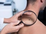 Blood test can predict metastasis risk in melanoma: Study