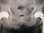 How women can reduce risk of hip fracture: Research(Shutterstock) How women can reduce risk of hip fracture: Research(Shutterstock)