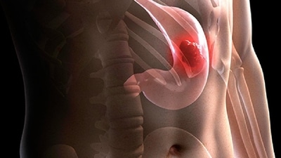 Are you suffering from acidity? Is there constant sickness and vomiting? Then, you will need to beware as these signs can indicate stomach cancer. Yes, that’s right! In an interview with HT Lifestyle, Dr Roy Patankar, Gastroenterologist and Director of Zen Multispecialty Hospital in Mumbai's Chembur, explained, “Stomach cancer (gastric cancer) affects one’s stomach. Situated in the upper part of your abdomen (your gastrointestinal lot, or GI), the stomach is responsible for processing the food that you eat. Not many people know about stomach cancer and fail to seek timely intervention. Did you know? Stomach cancer can happen to anyone irrespective of their age. Thus, it will be imperative for you to watch out for various red flags of this type of cancer.” He listed the following as the signs of stomach cancer that you shouldn’t ignore: (Twitter/WebMD) Are you suffering from acidity? Is there constant sickness and vomiting? Then, you will need to beware as these signs can indicate stomach cancer. Yes, that’s right! In an interview with HT Lifestyle, Dr Roy Patankar, Gastroenterologist and Director of Zen Multispecialty Hospital in Mumbai's Chembur, explained, “Stomach cancer (gastric cancer) affects one’s stomach. Situated in the upper part of your abdomen (your gastrointestinal lot, or GI), the stomach is responsible for processing the food that you eat. Not many people know about stomach cancer and fail to seek timely intervention. Did you know? Stomach cancer can happen to anyone irrespective of their age. Thus, it will be imperative for you to watch out for various red flags of this type of cancer.” He listed the following as the signs of stomach cancer that you shouldn’t ignore: (Twitter/WebMD)