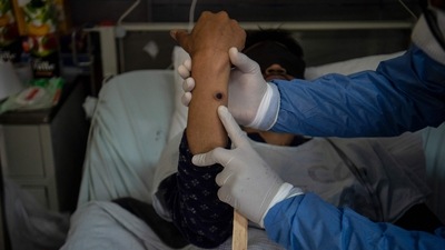 US plans end to mpox public health emergency in January (Photo by Ernesto BENAVIDES / AFP) US plans end to mpox public health emergency in January (Photo by Ernesto BENAVIDES / AFP)