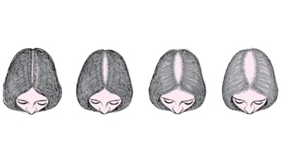 Female pattern baldness: Types, causes and treatment (Twitter/_thttallgirl_) Female pattern baldness: Types, causes and treatment (Twitter/_thttallgirl_)