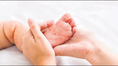 Under the ongoing outbreak response immunisation (ORI) being undertaken by the civic body, 14.7% of the children between 9 months to 5 years of age have received the special dose of measles vaccine while 30.8% of those between 6 months and 9 months have received the zero dose. (Shutterstock)