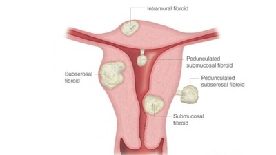 Multiple fibroids: Treatment options, management of uterine myomas or leiomyomas (Twitter/4Wildfire) Multiple fibroids: Treatment options, management of uterine myomas or leiomyomas (Twitter/4Wildfire)