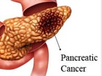 Killing pancreatic cancer with T cells that supercharge themselves: Research(Yahoo) Killing pancreatic cancer with T cells that supercharge themselves: Research(Yahoo)