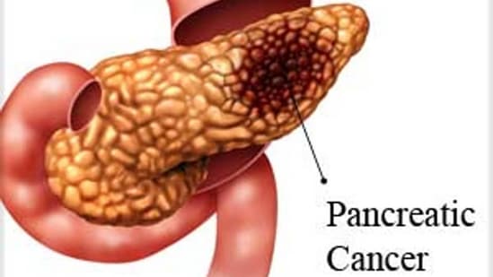 Killing pancreatic cancer with T cells that supercharge themselves: Research(Yahoo)