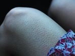 Experts on ways to take care of Keratosis Pilaris or ‘chicken skin’ this winter (Twitter/prettykentangg) Experts on ways to take care of Keratosis Pilaris or ‘chicken skin’ this winter (Twitter/prettykentangg)