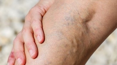 Are you feeling embarrassed because of those blue veins on the legs? Unable to wear your favorite dress due to the nasty varicose veins? Is this problem stealing your peace of mind? Then, you need not worry anymore. Be at ease as we list down a few treatment options for you. It is a known fact that varicose veins are quite painful and will give you a tough time. So, just consult an expert without any delay to minimize the appearance of these veins and lead a healthy life. Remember to follow the instructions given by the doctor only. Following are some of the treatment options for varicose veins, as suggested by Dr Rajan Modi: (Twitter/vein_at) Are you feeling embarrassed because of those blue veins on the legs? Unable to wear your favorite dress due to the nasty varicose veins? Is this problem stealing your peace of mind? Then, you need not worry anymore. Be at ease as we list down a few treatment options for you. It is a known fact that varicose veins are quite painful and will give you a tough time. So, just consult an expert without any delay to minimize the appearance of these veins and lead a healthy life. Remember to follow the instructions given by the doctor only. Following are some of the treatment options for varicose veins, as suggested by Dr Rajan Modi: (Twitter/vein_at)