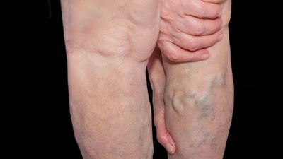 In an interview with HT Lifestyle, Dr Rajan Modi, Laparoscopy and Laser Surgeon at House of Doctors, told Zarafshan Shiraz, “One with varicose veins may showcase symptoms such as swollen feet and ankles, burning and throbbing sensation in one’s leg and one’s legs may feel heavy and cramps but the symptoms will vary from one individual to another. One can suffer from it owing to pregnancy, obesity and being overweight along with standing or sitting for a longer time. It is essential to manage this problem with the help of an expert.” (Shutterstock) In an interview with HT Lifestyle, Dr Rajan Modi, Laparoscopy and Laser Surgeon at House of Doctors, told Zarafshan Shiraz, “One with varicose veins may showcase symptoms such as swollen feet and ankles, burning and throbbing sensation in one’s leg and one’s legs may feel heavy and cramps but the symptoms will vary from one individual to another. One can suffer from it owing to pregnancy, obesity and being overweight along with standing or sitting for a longer time. It is essential to manage this problem with the help of an expert.” (Shutterstock)