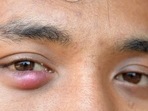 Can stye, pimple or eyelid bumps make your eyes critically ill? Experts answer (Twitter/villagetipss) Can stye, pimple or eyelid bumps make your eyes critically ill? Experts answer (Twitter/villagetipss)