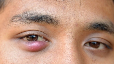 Can stye, pimple or eyelid bumps make your eyes critically ill? Experts answer (Twitter/villagetipss) Can stye, pimple or eyelid bumps make your eyes critically ill? Experts answer (Twitter/villagetipss)
