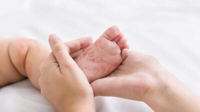 Measles virus. Mother holding tiny baby foot with red rash, closeup (Shutterstock) Measles virus. Mother holding tiny baby foot with red rash, closeup (Shutterstock)