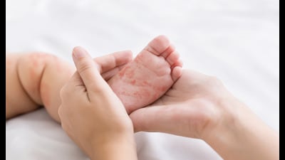 According to the World Health Organization (WHO), Rubella is a contagious viral infection that can be prevented with a vaccine and is distinguished by a distinctive red rash. (REPRESENTATIVE IMAGE)