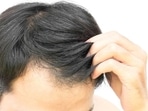 “Baldness, a condition characterized by excessive hair loss, can be triggered by various factors, including age, genetics, nutrient deficiencies, lifestyle choices, scalp infections, stress, medications, and certain medical conditions. Categorized based on causes, gender, and age, types of baldness can vary, like female pattern baldness, alopecia, male pattern baldness”. says, Dr. Dimple Jangda, Ayurveda & Gut Health Coach, in her recent Instagram post. She further shared remedies for bald patches. (Getty Images/iStockphoto)