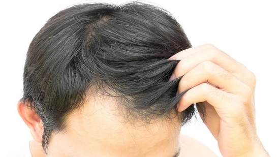 “Baldness, a condition characterized by excessive hair loss, can be triggered by various factors, including age, genetics, nutrient deficiencies, lifestyle choices, scalp infections, stress, medications, and certain medical conditions. Categorized based on causes, gender, and age, types of baldness can vary, like female pattern baldness, alopecia, male pattern baldness”. says, Dr. Dimple Jangda, Ayurveda & Gut Health Coach, in her recent Instagram post. She further shared remedies for bald patches. (Getty Images/iStockphoto)
