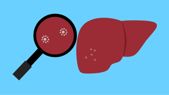 Potential new targets identified in non-alcoholic fatty liver disease: Research(Image by Mohamed Hassan from Pixabay )