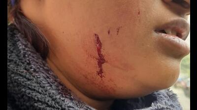 Lucknow woman injured in dog attack (ht)