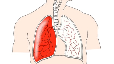 Lung disease's early warning symptoms get ignored. Watch out for these signs (Image by Clker-Free-Vector-Images from Pixabay ) Lung disease's early warning symptoms get ignored. Watch out for these signs (Image by Clker-Free-Vector-Images from Pixabay )