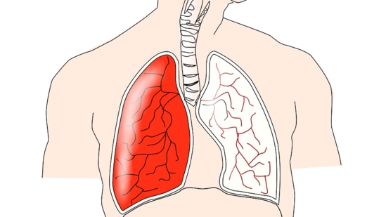 Lung disease's early warning symptoms get ignored. Watch out for these signs (Image by Clker-Free-Vector-Images from Pixabay )