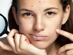 Ace your period skin: Ways to prevent acne breakouts before your periods(Shutterstock) Ace your period skin: Ways to prevent acne breakouts before your periods(Shutterstock)