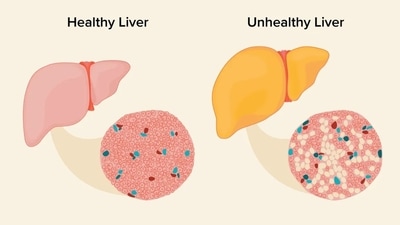 Diet, lifestyle modifications to treat fatty liver (Photo by Twitter/144Health) Diet, lifestyle modifications to treat fatty liver (Photo by Twitter/144Health)