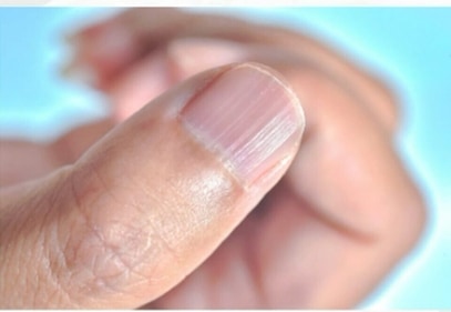 Longitudinal lines on nails (Instagram/Dr Nitika Kohli) Longitudinal lines on nails (Instagram/Dr Nitika Kohli)