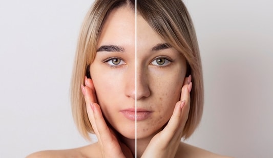 It is important to know the causes of your acne to take control and achieve clear, healthy skin. (freepik)