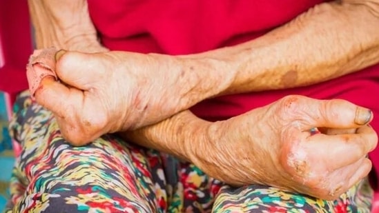 World Leprosy Day 2023: Signs and symptoms of leprosy, how it spreads, treatment(Shutterstock)