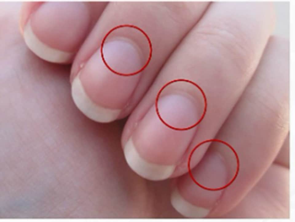 I recently noticed dents on my nails. Does that mean anything? Do I have a  disease? - Quora