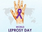 World Leprosy Day 2023: Expert debunks Hansen’s disease myths, shares facts to battle leprosy 